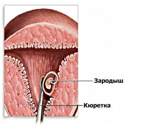 Как делают хирургический аборт